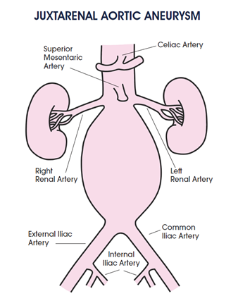 We have 3 new diagrams designed to support vascular nurses and their teams: Juxtarenal Aortic Aneurysm, Pararenal Aortic Aneurysm and the Aortic Arch.? svnnet.org/page/Diagrams