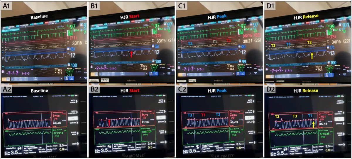 Beyond static measures: The utility of bedside dynamic volume loading during Impella supported-CS <a href="/beaini_hadi/">Hadi Beaini, MD</a> <a href="/UTSWMedCenter/">UT Southwestern Medical Center</a> <a href="/utswheart/">UTSW Heart</a> #AHAJournals ahajrnls.org/4oo56Vq