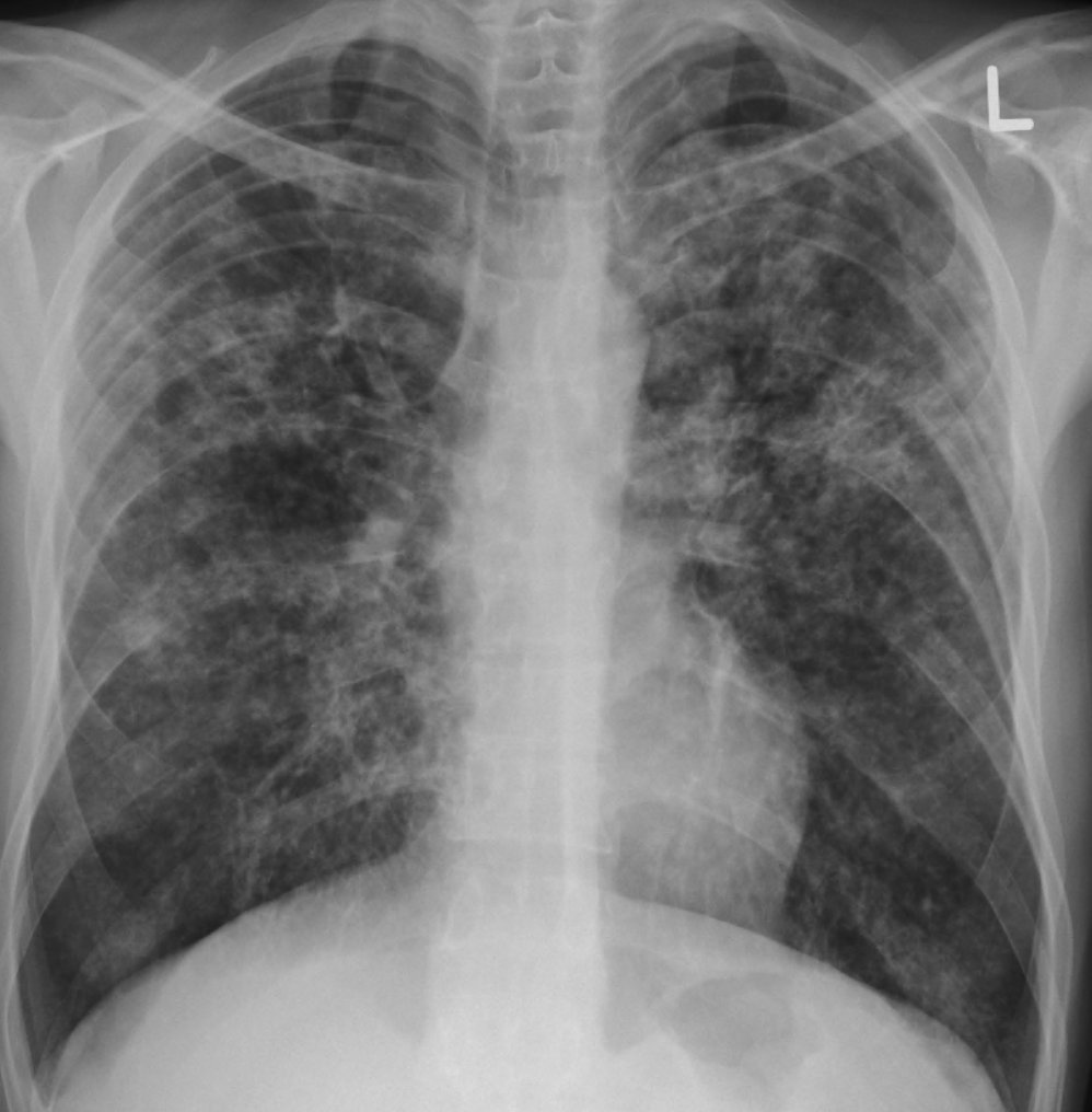 USMLEStepStudy's tweet image. Miliary tuberculosis - subacute or chronic febrile respiratory illness; Labs: Anemia, hypoalbuminemia, hyponatremia, elevated alk phos level, NL bilirubin, NL AST, NL ALT, LDH mild elevation; Extrapulmonary = lymph nodes, liver, bone marrow, CNS/meninges