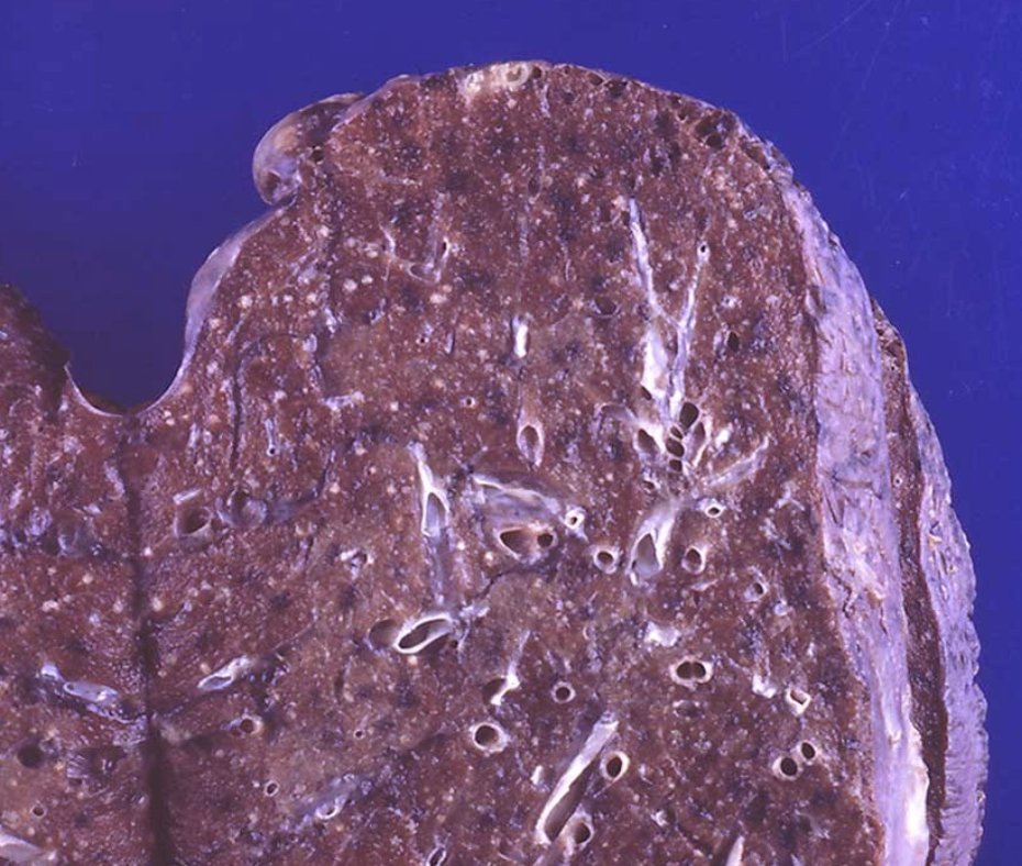 USMLEStepStudy's tweet image. Miliary tuberculosis - subacute or chronic febrile respiratory illness; Labs: Anemia, hypoalbuminemia, hyponatremia, elevated alk phos level, NL bilirubin, NL AST, NL ALT, LDH mild elevation; Extrapulmonary = lymph nodes, liver, bone marrow, CNS/meninges