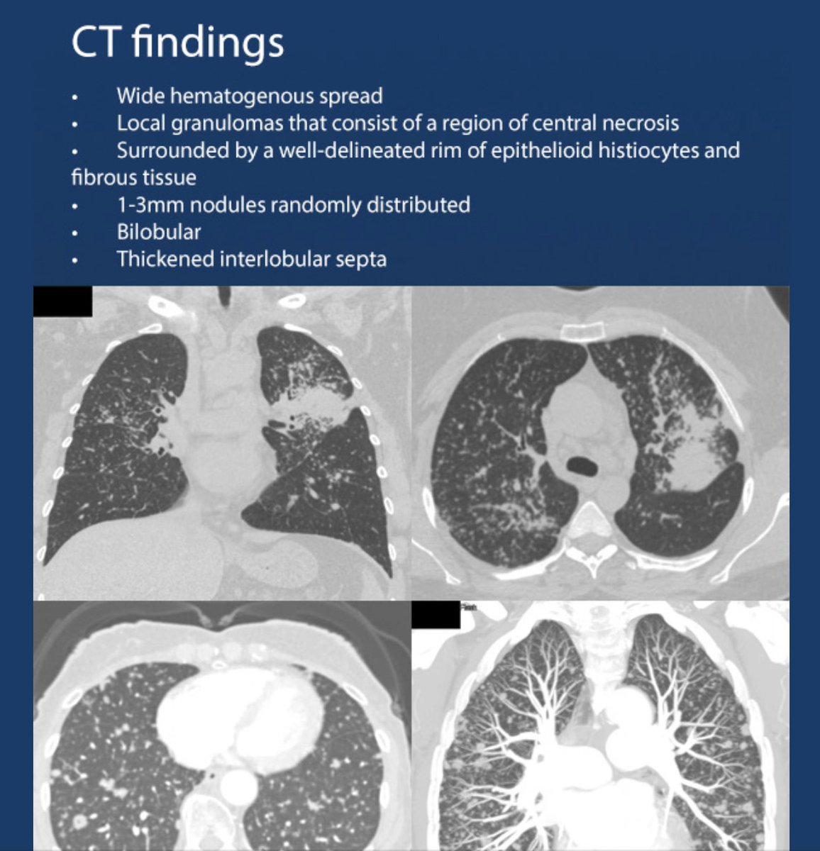USMLEStepStudy's tweet image. Miliary tuberculosis - subacute or chronic febrile respiratory illness; Labs: Anemia, hypoalbuminemia, hyponatremia, elevated alk phos level, NL bilirubin, NL AST, NL ALT, LDH mild elevation; Extrapulmonary = lymph nodes, liver, bone marrow, CNS/meninges