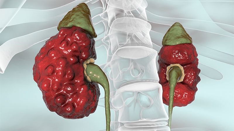 Gene Variants Drive Heart Risks in Polycystic Kidney Disease
ms.spr.ly/6013sNtfR
