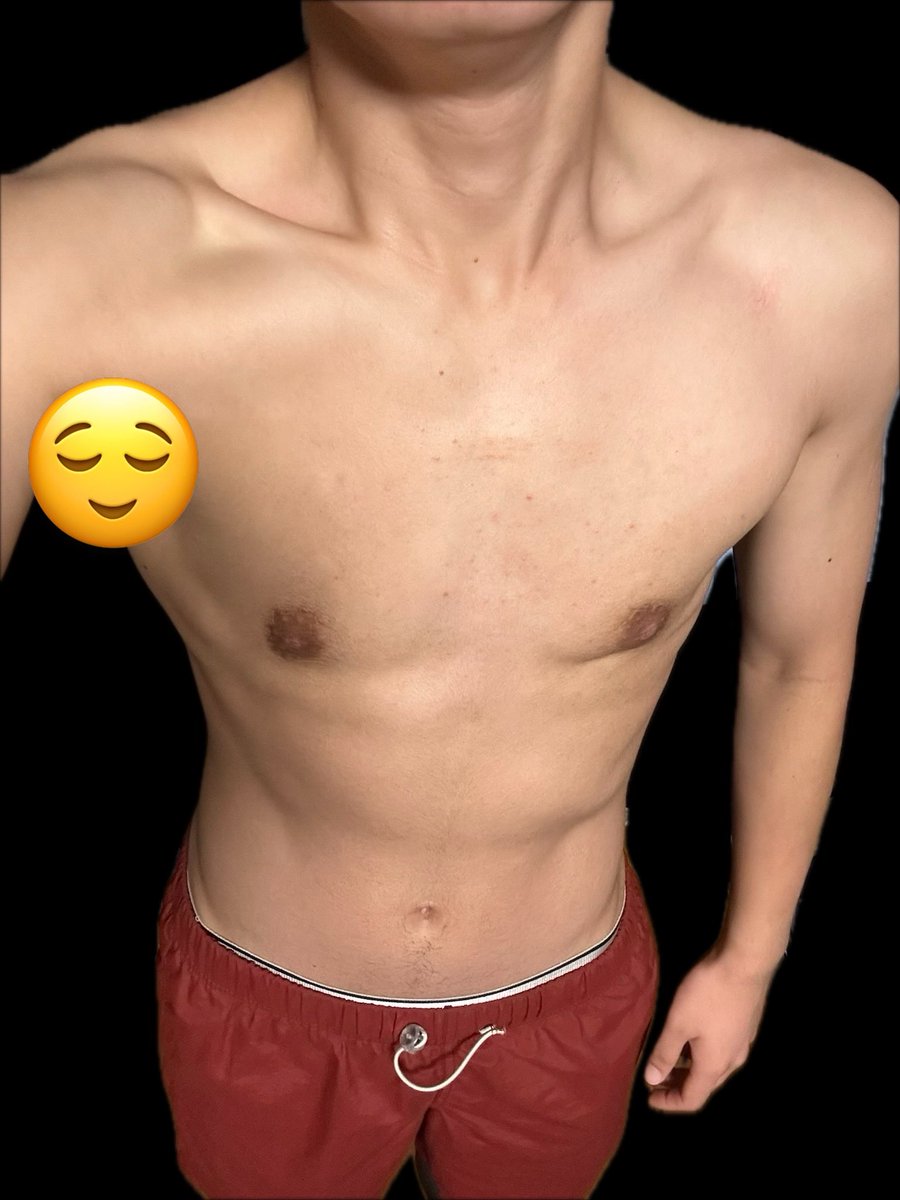 koshilogftm's tweet photo. 気づいたら乳頭縮小から半年以上経ってた
めっちゃ遅いけど良くなってきてます
乳輪もちょっとずつ小さくなってきた
向かって右の肋骨が出てて、下乳ライン出現笑 https://t.co/Ev5CnTRCl0