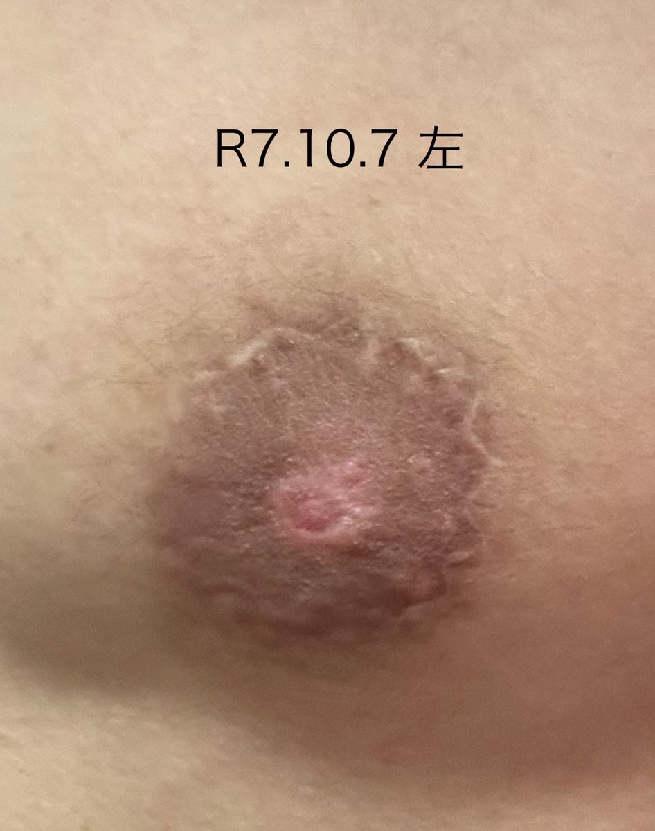koshilogftm's tweet photo. 気づいたら乳頭縮小から半年以上経ってた
めっちゃ遅いけど良くなってきてます
乳輪もちょっとずつ小さくなってきた
向かって右の肋骨が出てて、下乳ライン出現笑 https://t.co/Ev5CnTRCl0