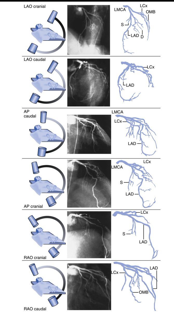 Standardized views for imaging the left coronary artery.