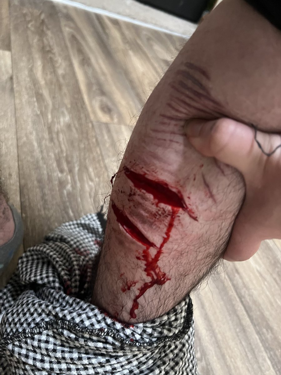 samwd8w's tweet photo. i hit a vein but it clotted overt and #shtwt i dont feel good https://t.co/pii3zCEamD