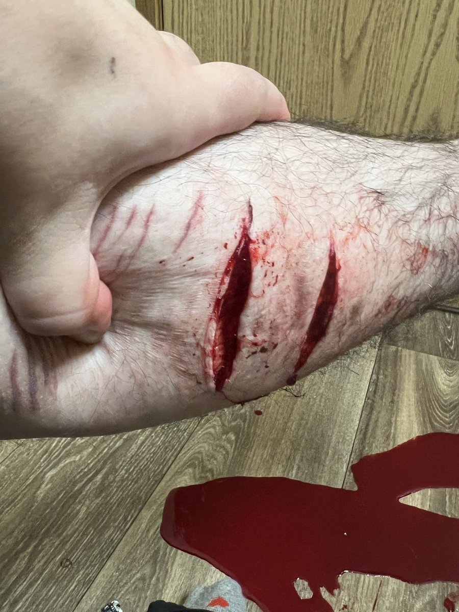 samwd8w's tweet photo. i hit a vein but it clotted overt and #shtwt i dont feel good https://t.co/pii3zCEamD
