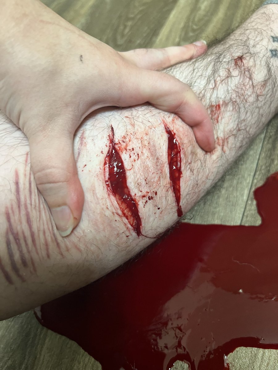 samwd8w's tweet photo. i hit a vein but it clotted overt and #shtwt i dont feel good https://t.co/pii3zCEamD