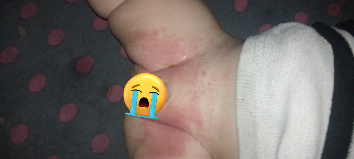 Please help my child who is in pain, crying and needs treatment, milk and clean diapers. Please donate even a small amount. #Gazahttps://chuffed.org/project/150407-please-help-wesel-her-6-children-with-food-medical-aid