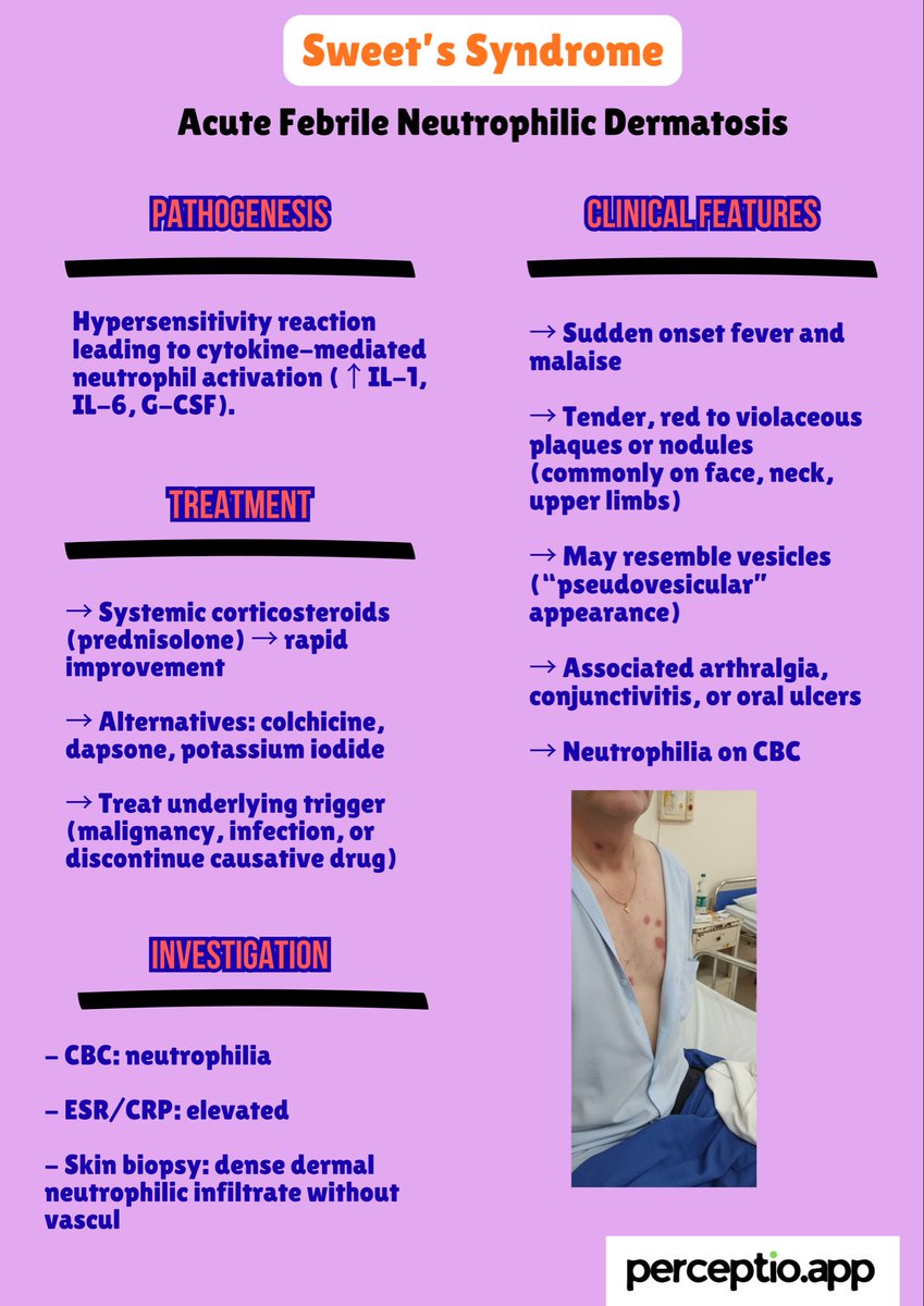 Sweet Syndrome (AFND) — Quick Summary

by perceptio.app