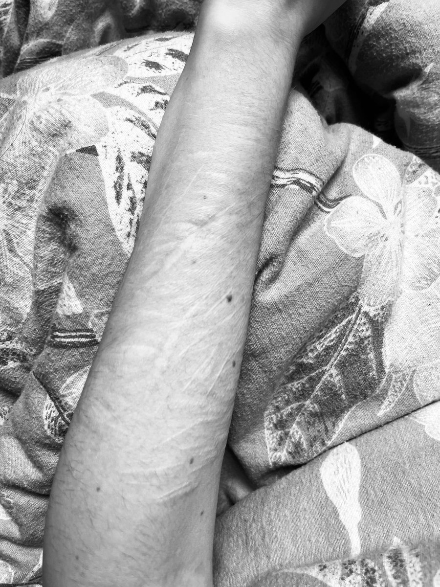 sueeeeeuue's tweet photo. scars https://t.co/zCsPLOi3H2