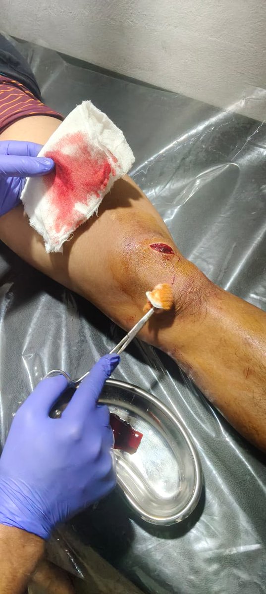 Commandant58Bn's tweet photo. On 17/10/25, Paolaldin Gangte (23 yrs/M) S/o- Lalte Gangte, Gothol vill accidentally fell down &amp; sustained serious injury at his left knee. Hospital staff of 58 Bn  imdtly provided the treatment. His siblings overwhelmed &amp; expressed their sincere gratititude for the hospitality. https://t.co/2H9orS5bZK