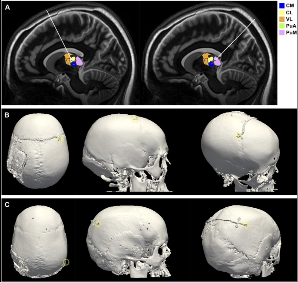 #ONSNew A Posterior Approach for Combined Targeting of the Centromedian Nucleus and Pulvinar for Responsive Neurostimulation bit.ly/42JLKBK by Chua et al <a href="/BrighamWomens/">Brigham and Women's Hospital</a> <a href="/dgolubMD/">Danielle Golub, MD, MSCI</a> <a href="/CNS_Update/">CNS</a>