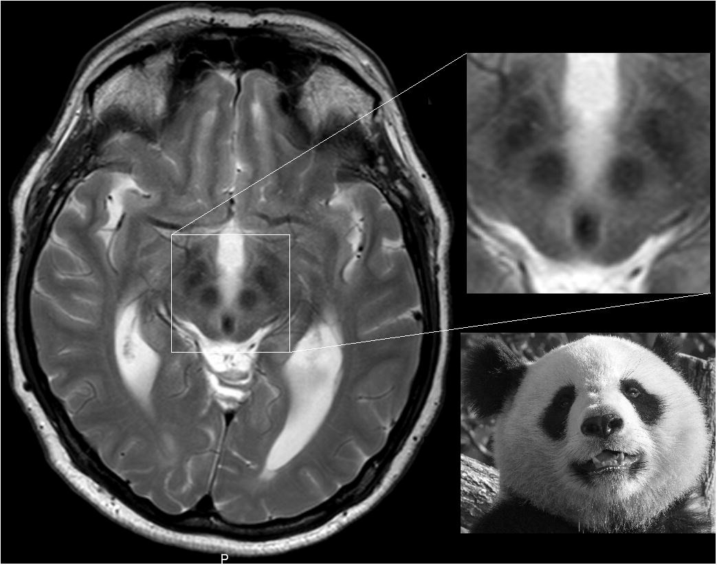 #NeuroradiologySign
🐼Face of the Giant Panda - Wilson Disease

Appearance:
🐼Hyperintense tegmentum (panda’s face)
👀Normal red nuclei (eyes)
👂Hypointense superior colliculi (ears)
👄Preserved signal in lateral portion of substantia nigra (mouth) 

#neurorads #FOAMed #Neurology
