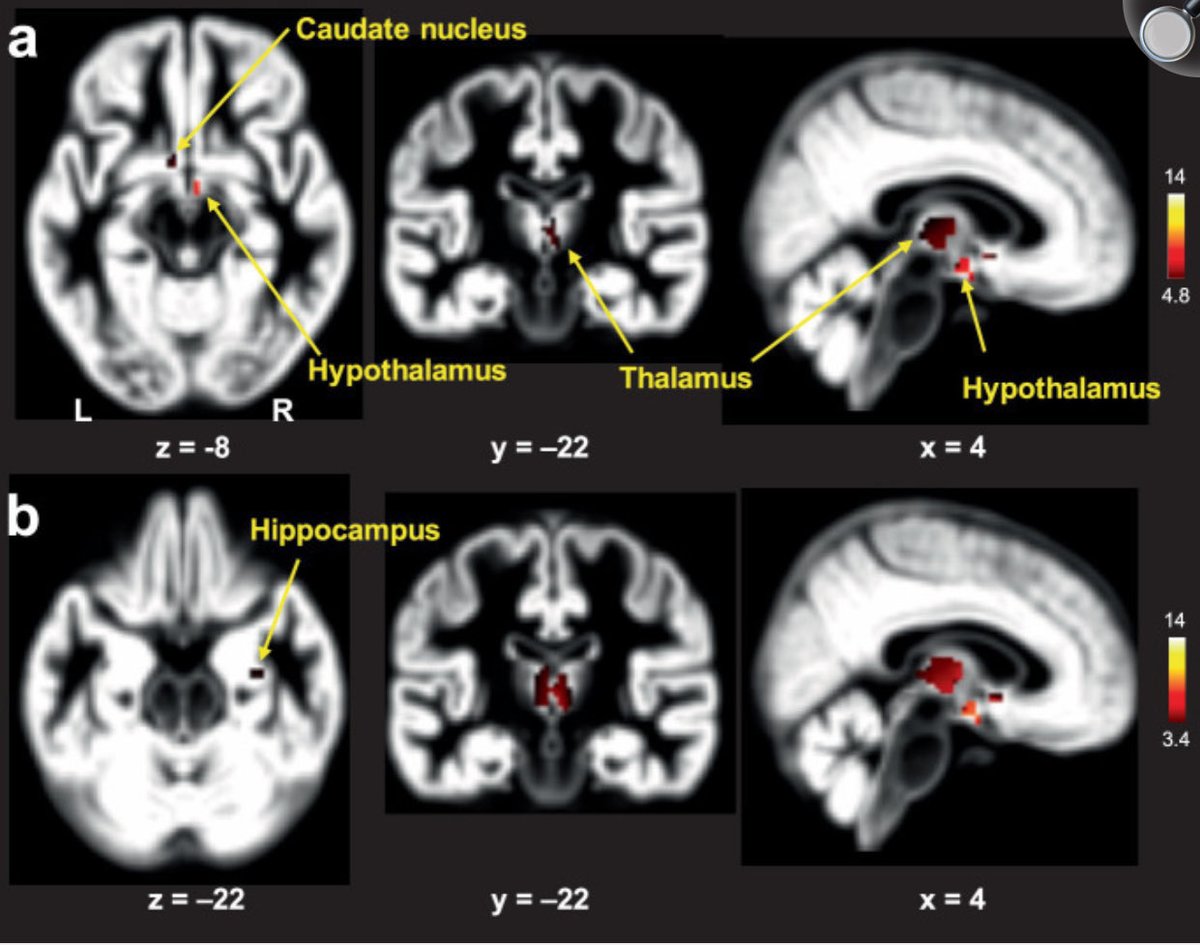 New paper examines hippocampal subfield volumes in FtMs on long-term testosterone therapy compared to female controls. It reports a larger right subiculum and some voxel-wise right hippocampal differences. These findings are interpreted as potential structural effects of chronic