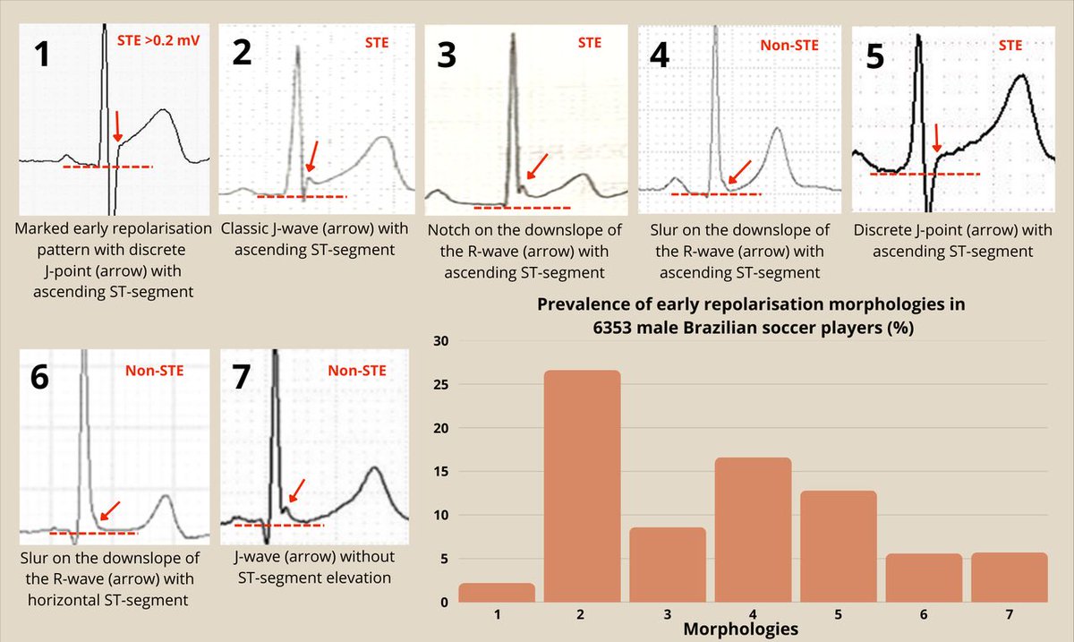 Heart_BMJ's tweet photo. Distinct early repolarisation patterns in male Brazilian soccer players: insights from a multicentre study https://t.co/P0cQyiVcGr https://t.co/2eYZgaWp2B