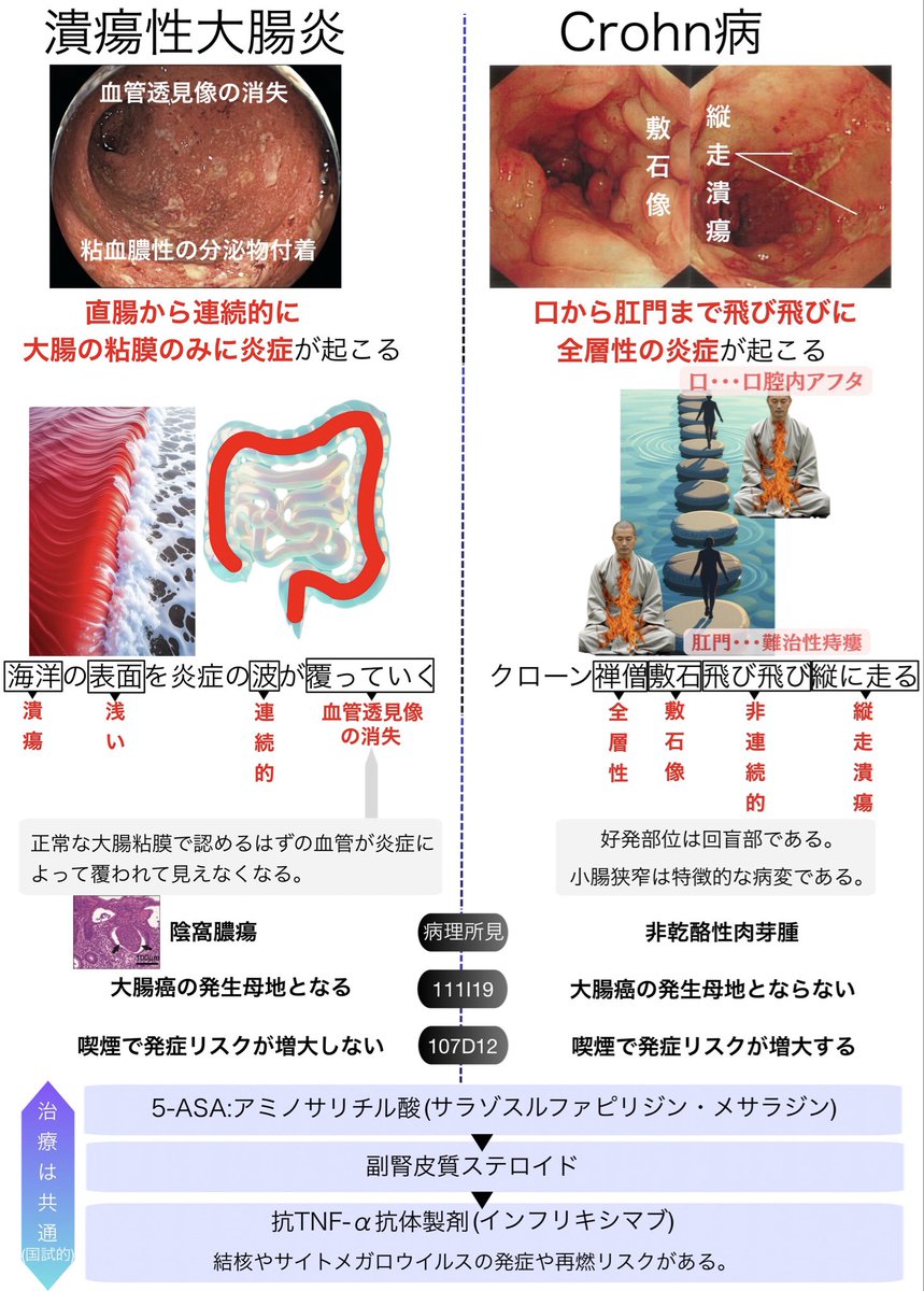 igakunote's tweet photo. 119A7  潰瘍性大腸炎の特徴的な所見は？
a 敷石像
b 縦走潰瘍
c 全層性炎症
d 難治性痔瘻
e 連続性病変
潰瘍性大腸炎とクローン病がこんがらがるのは全ての医学生が通る道です！
こういうのは無理矢理イメージで覚えることも大切です！
ほぼ全ての国試で問われた事項をまとめています！ https://t.co/iFKqUzkPVi