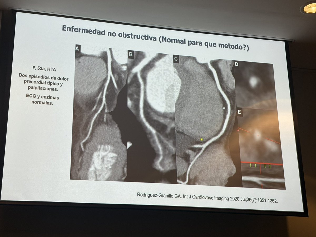 Mesa de síndrome coronario crónico:
Enfocándonos en la placa en  #SAC25
Muy buena la pregunta:
Coronaria normal. ..normal para que método? <a href="/matiasrg/">Matias Rodriguez G 🇦🇷 ⭐⭐⭐</a> <a href="/JuradoRomanAl/">Alfonso Jurado-Román</a> <a href="/Monicaferqu/">Mónica Fernández Quero</a> <a href="/belcid7/">Belén Cid Alvarez</a> <a href="/jmmoreiras/">Javi Moreiras</a> <a href="/rmartinreyes/">Dr. Roberto Martin-Reyes</a>