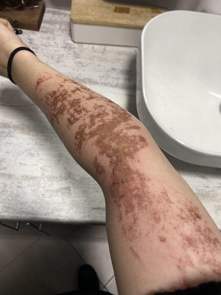 Когда я говорила что хочу рукав я имела ввиду татуху а не огромный шрам от раскаленного антифриза