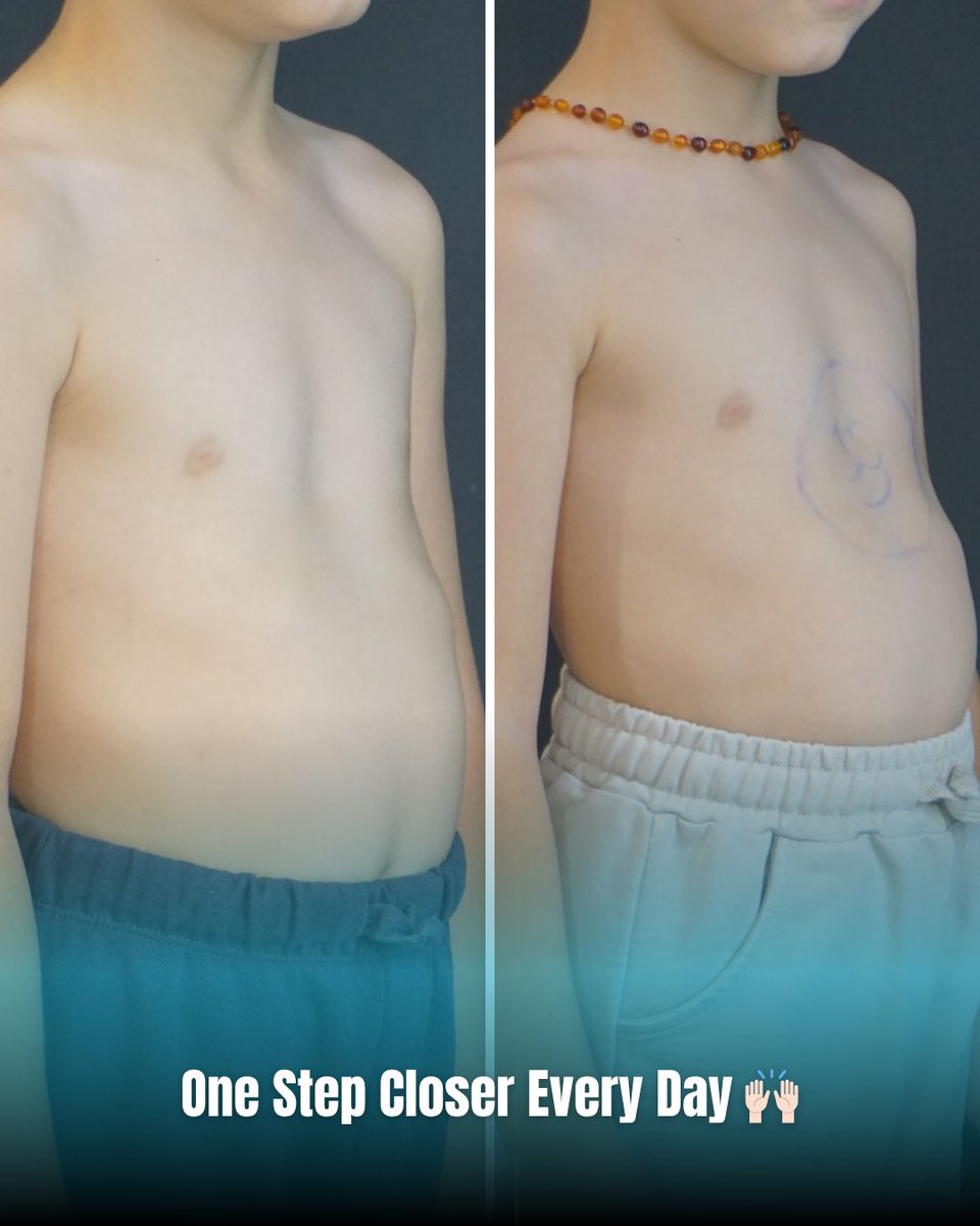 drpektus's tweet image. Just 1 month, and a remarkable transformation! 💪🏻
Our patient, diagnosed with Pectus Excavatum (funnel chest), began vacuum therapy — and by the 6th week, the chest depression improved from 14.87 mm to 9.81 mm.

#pectusexcavatum #vacuumtherapy #chestsurgery #minimalinvasive