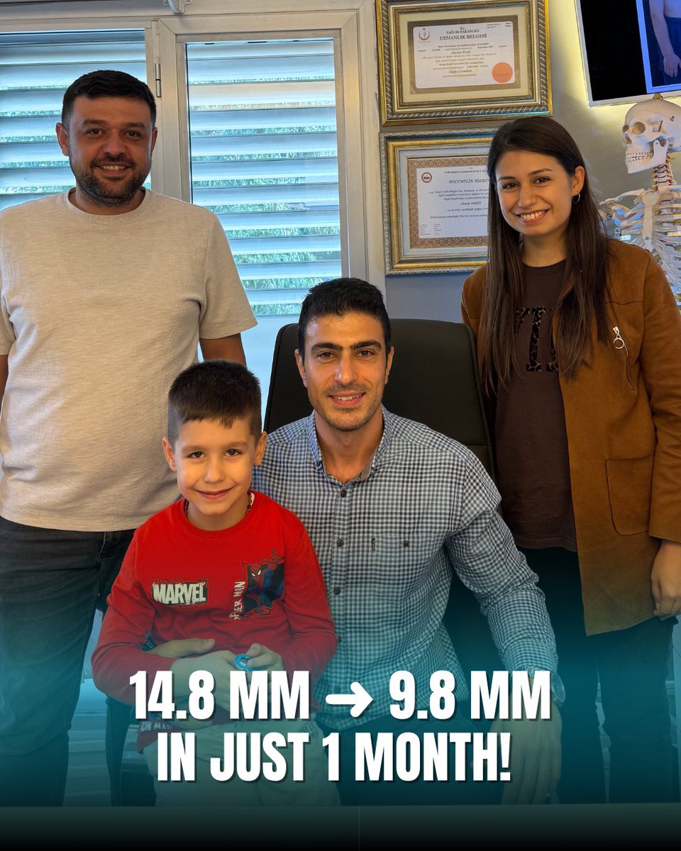 drpektus's tweet image. Just 1 month, and a remarkable transformation! 💪🏻
Our patient, diagnosed with Pectus Excavatum (funnel chest), began vacuum therapy — and by the 6th week, the chest depression improved from 14.87 mm to 9.81 mm.

#pectusexcavatum #vacuumtherapy #chestsurgery #minimalinvasive