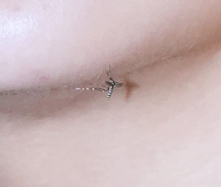 basbasbas0131's tweet image. 秋ですが夏の風物詩🍂🦟
1枚目は以外は修正してもらう前😂
恥ずかぴ😳
カメラ高性能ゆえの…
📷　@hama_ryunosuke