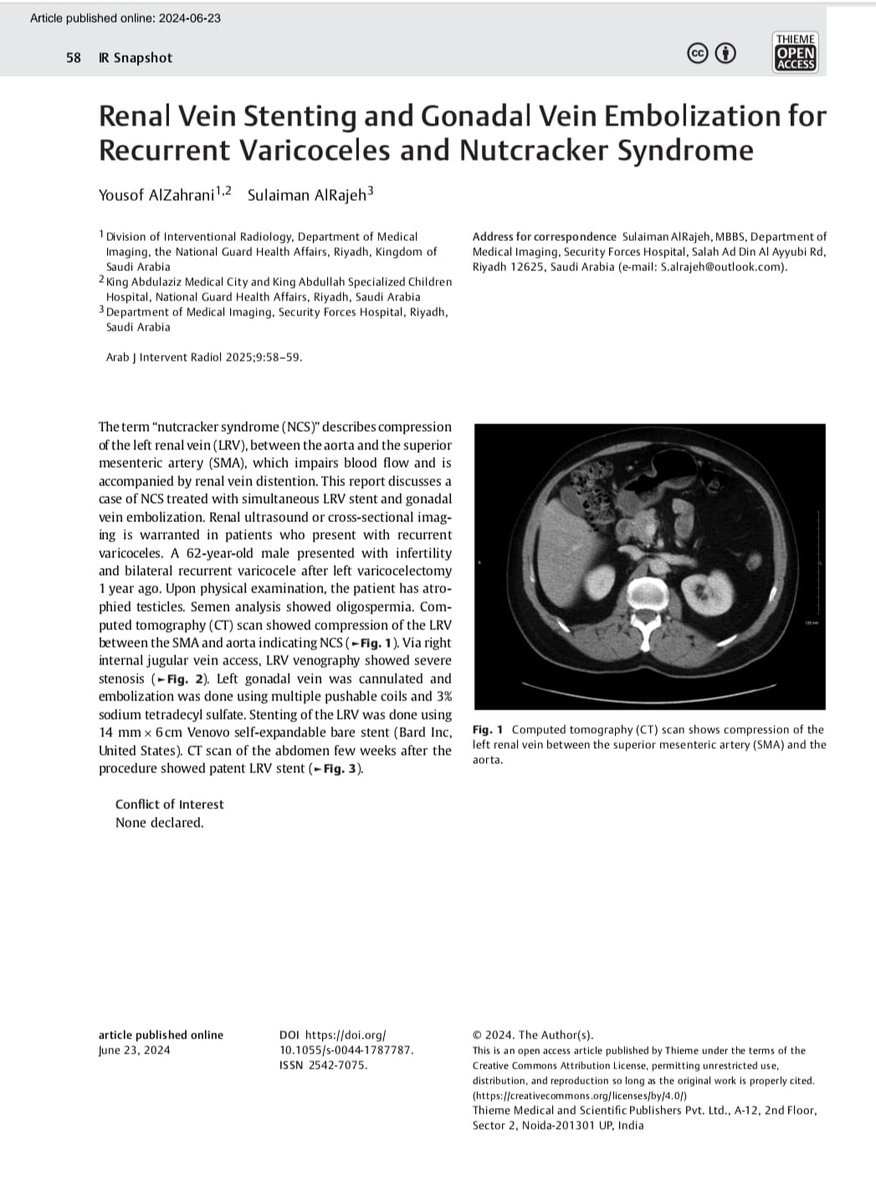 Arabjir's tweet photo. ✨#AJIR Articles :
IR Snapshots: Renal Vein Stenting and Gonadal Vein Embolization for Recurrent Varicoceles and Nutcracker Syndrome @pairsmedia @marabi2004
📌Read Now: https://t.co/HowhaWg20Q
#InterventionalRadiology
#Nutcrakersyndrome
#Varicocele https://t.co/1zXhaZwaVg