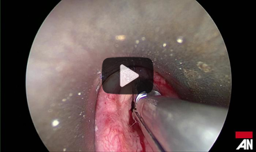anesthesianews's tweet photo. Medical mavens, sharpen your skills with the Airway on Demand (AOD) video series by Dr. William Rosenblatt of Yale! #MedEd #Anesthesiology #AirwayManagement https://t.co/jxGyMkRLKn https://t.co/wPm64oeKnO