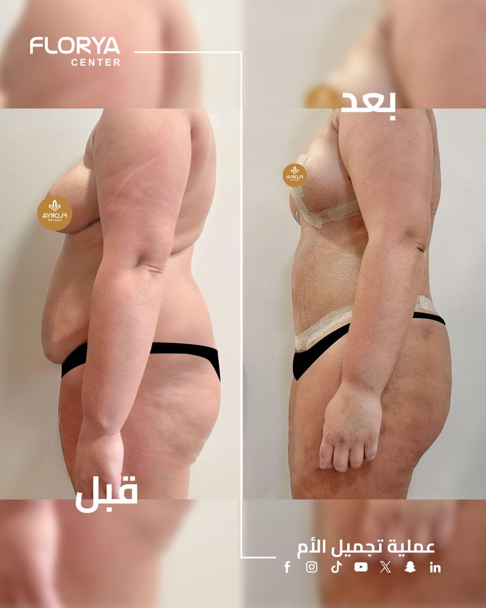 FloryaHospital's tweet photo. تحوّل جميل يعيد الثقة والجمال! 💫
عملية تجميل الأم صُمّمت لتمنحكِ مظهراً متناسقاً وشعوراً متجدداً بعد الحمل والولادة، تجمع بين شد البطن ورفع الصدر وتحسين ملامح الجسم لتستعيدي أناقتكِ الطبيعية بكل أنوثة.
#تجميل_الأم #شد_البطن #رفع_الثدي #عمليات_تجميل #قبل_وبعد #جراحة_تجميلية https://t.co/l9DLtHg4WT