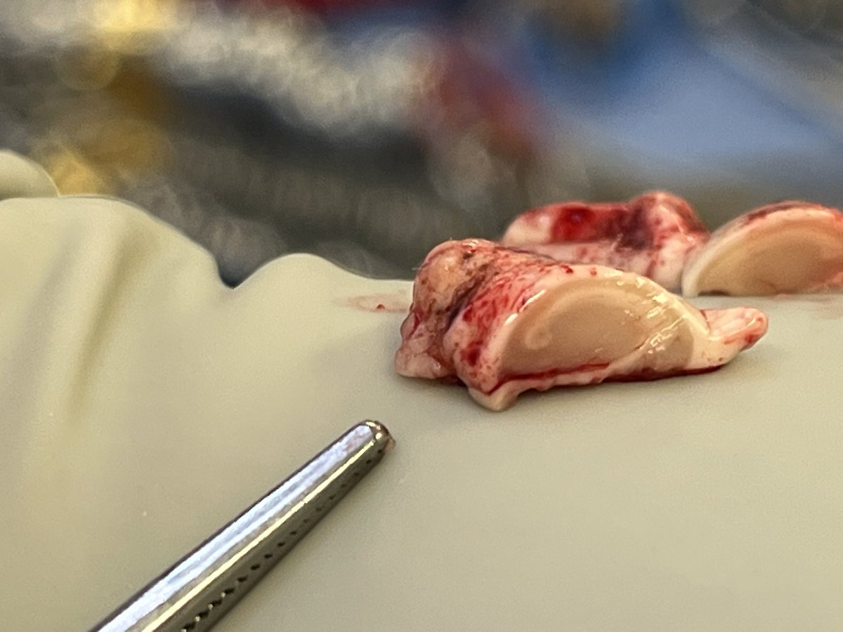 Great example of mesial temporal sclerosis following a temporal lobectomy. Atrophic and rubbery, but great cross sectional anatomy!

#epilepsy <a href="/CwruEpilepsy/">Case Western Reserve Univ/UH Epilepsy Program</a> <a href="/UHCLENeurosurg/">University Hospitals of Cleveland Neurosurgery</a> <a href="/UHhospitals/">University Hospitals</a>