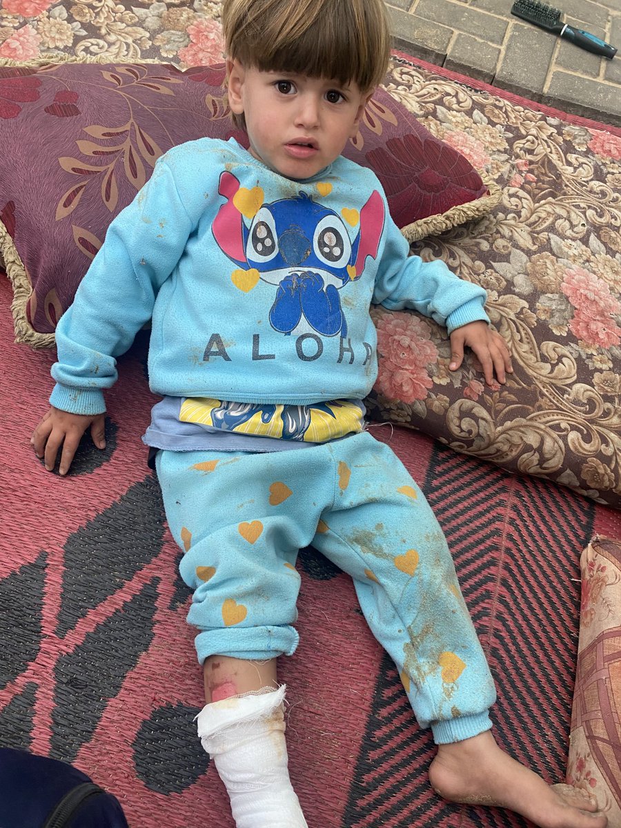 khald_mwns's tweet image. My little brother Yazan cries in pain... 💔
Every day and night, his faint voice trembles with the burning pain in his foot. He can't walk or sleep. He just cries, begging for a cure. 😢
We're doing our best, but Yazan needs special medical care and treatment that we can't…