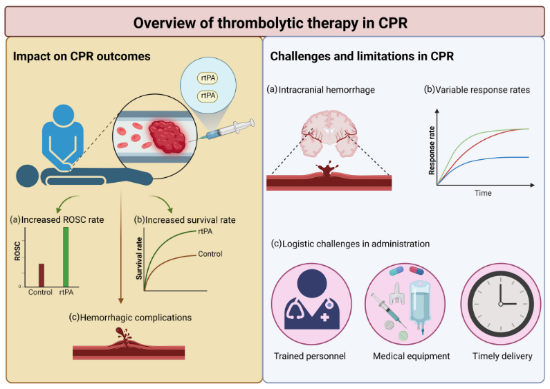 Thrombolytic therapy during CPR 

➡️ rtPA may boost ROSC but survival gains uncertain
➡️ Best signal in suspected PE with careful selection
➡️ Bleeding—especially ICH—is the trade off
➡️ Early, pragmatic 50–100 mg regimens under study

CCR Journal Watch
criticalcarereviews.com/latest-evidenc…