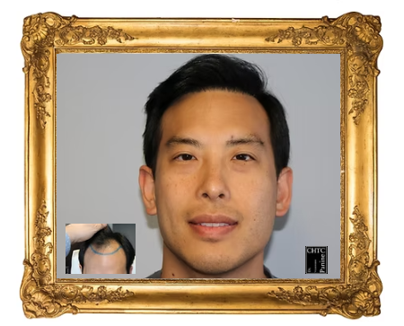 Where do you go for the best hair transplant in the US? Hands down, that would be Dr. Panine at Chicago Hair Transplant Clinic.   

Why?  Chicago Hair Transplant Clinic stands out because Dr. Panine, with over 31 years of experience and 6,000 surgeries, personally performs every