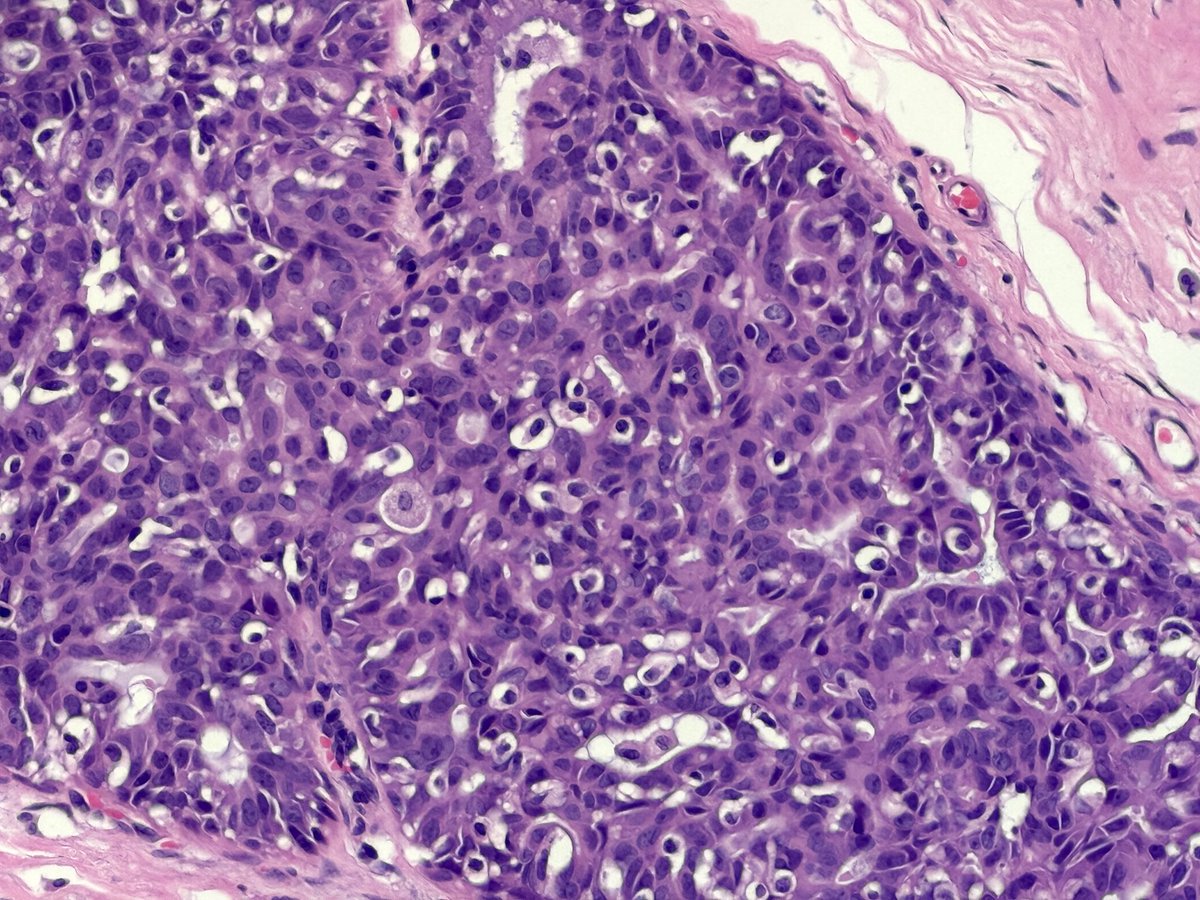 A florid example of usual epithelial hyperplasia. No requirement 4 immunohistochemistry in this case as its a polymorphic classic 😉. If U wanted to confirm - CK5+&amp; variable ER expression.
Hope y’all have a great weekend 💚
#pathology 
#BreastPath
