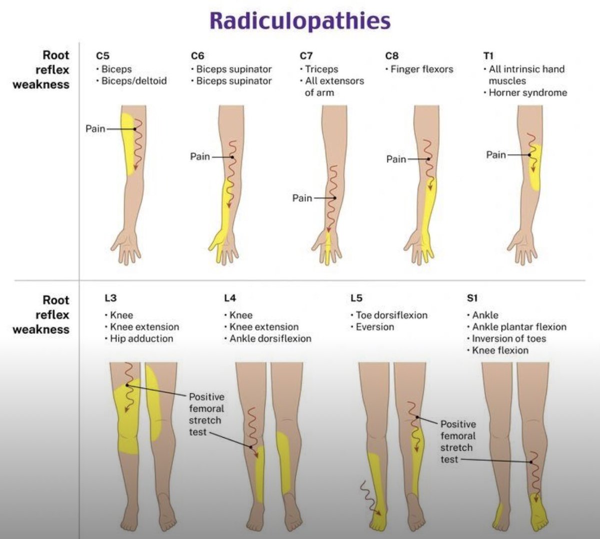 Radiculopathy occurs when a nerve in the spine gets pinched, causing pain, tingling, or weakness along the arm or leg  Here you can see different types and their symptoms. 
How do you treat radiculopathy? 
#radiculopathy #pain #nervepain #neuralgia #health #BamBam #patlama #MECFS
