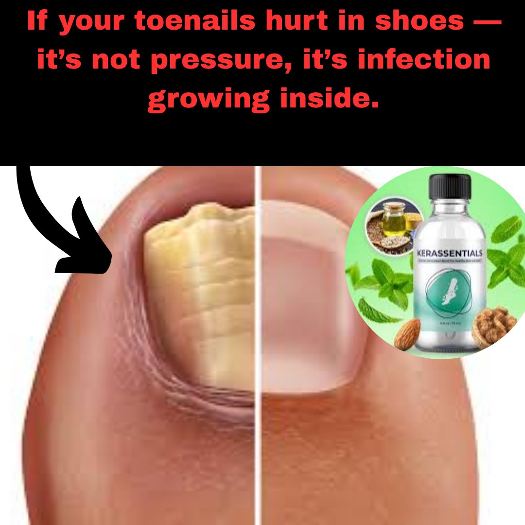 kumar_as26410's tweet photo. Stop hiding your nails — start healing them.
Kerassentials supports long-term nail clarity, health, and protection.
Beautiful nails aren’t luck — they’re care.
https://t.co/6VoalgCMVl
#Kerassentials #NailRepair #SelfCare https://t.co/Mf7gQq5t1X