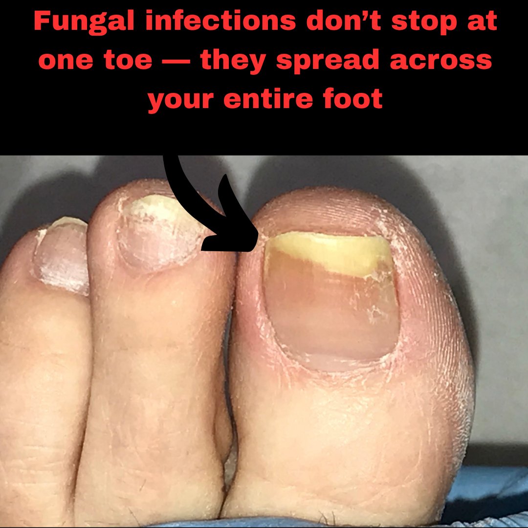 kumar_as26410's tweet photo. Healthy, fungus-free nails are possible.
Kerassentials gives your nails the natural defense they deserve.
DM us to learn how it works.
https://t.co/6VoalgCMVl
#Kerassentials #NailCareRoutine #ConfidenceStartsHere https://t.co/PNXnwULGF7