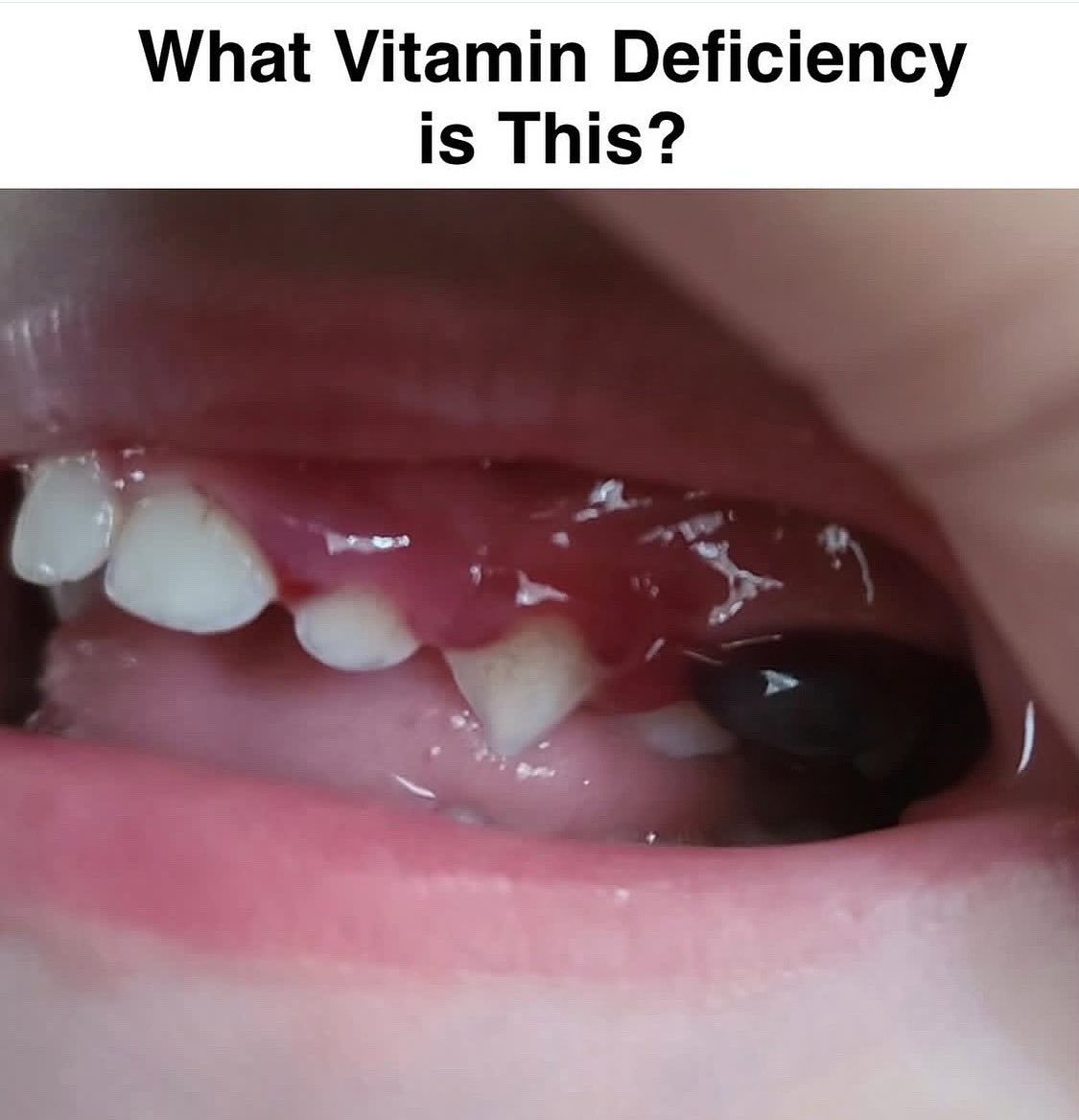 Paul_Wischmeyer's tweet image. ❓ 3-year-old with spontaneous mouth lesion and severe leg weakness. Which vitamin is he missing and why?
#vitamin #vitamins #nutrients