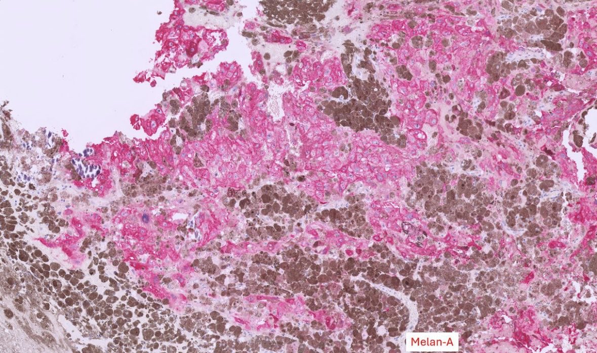 Mass of spine 32M. Malignant Melanotic Nerve Sheath Tumor (MMNST). Heavily pigmented tumor. Note the frequent psammoma bodies here, a clue to the correct diagnosis. Syndrome/molecular? Other features of this syndrome? #pathx #pathtwitter #neuropath #neuropathology #cnspathology