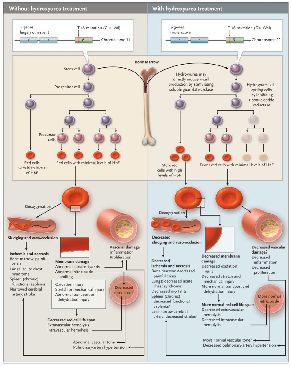 A simple oral drug that ⤴️ HbF and still remains one of the most impactful therapies in sickle cell care 💪🏽

The humble hydroxyurea 🙌🏽

⤴️HbF = ⤵️HbS
Hydroxyurea = ⤴️NO = ⤵️vascular injury
 nejm.org/doi/full/10.10…