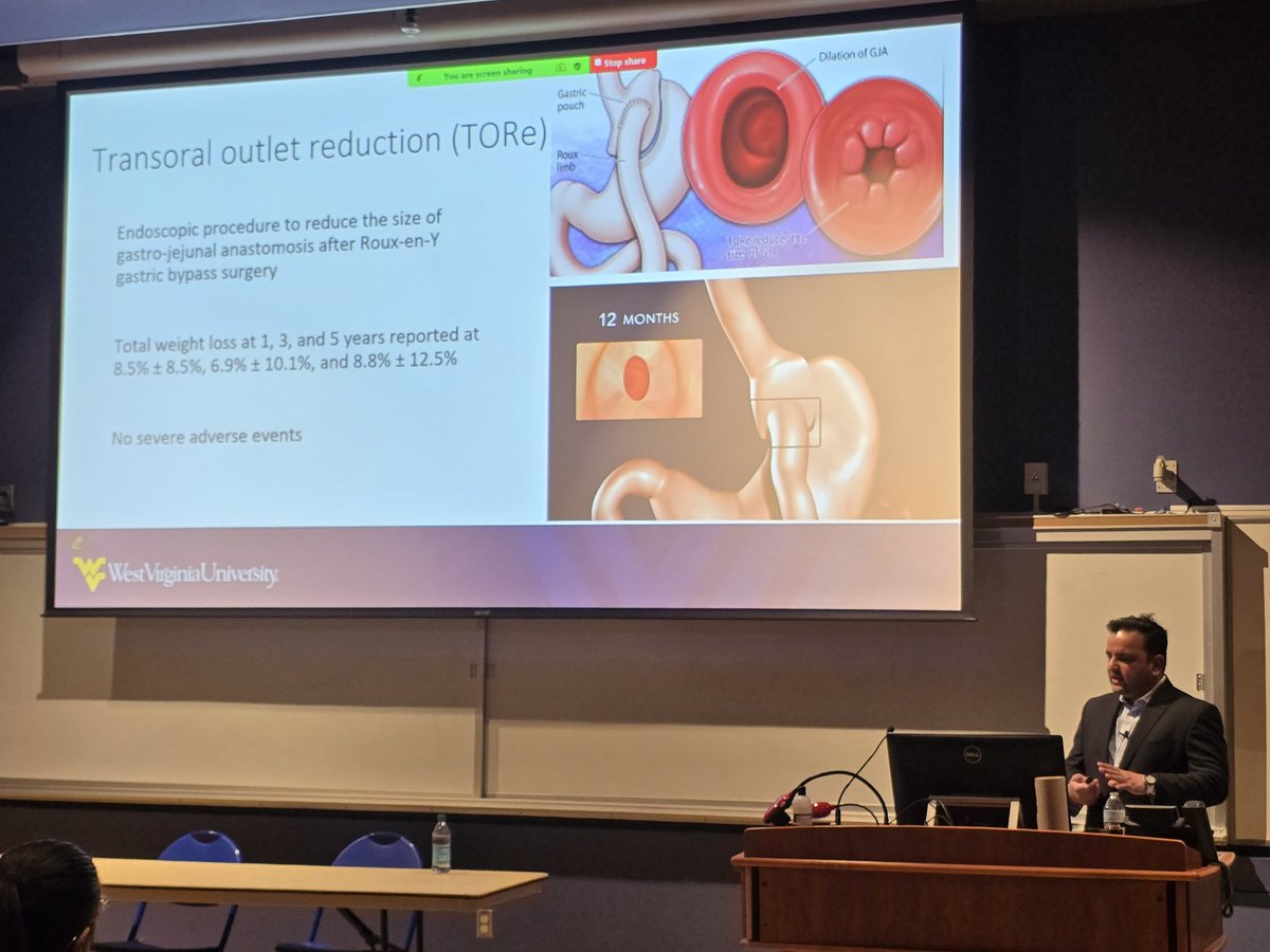 SanyaGoswami4's tweet image. Highly educational and cutting edge @wvudeptofmed Grand Rounds presented by Dr. @shailsingh on novel endoscopic therapy in the realm of #obesitymedicine
#WomeninGI #AEF
