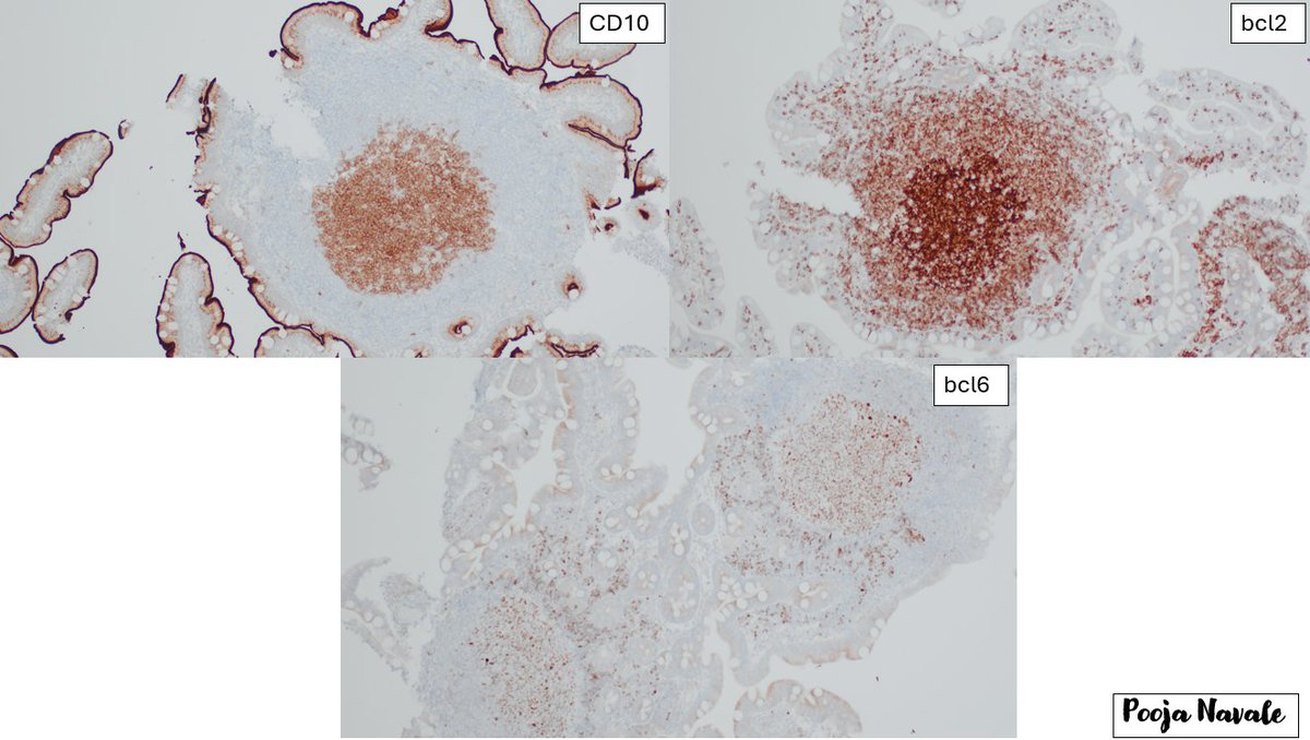 navale_pooja's tweet photo. Lymphomas are rare in the duodenum - but this case surprised us: an incidental duodenal-type follicular lymphoma discovered in a polyp! #PathTwitter #Gipath
@CooperPathology https://t.co/1DoQ00CvOt