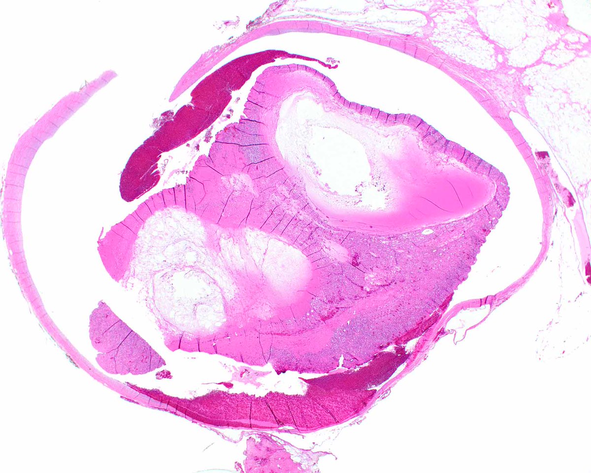 LizMontgomeryMD's tweet photo. Intravascular anastomosing hemangioma. 
John I, Folpe AL. Anastomosing Hemangiomas Arising in Unusual Locations: A Clinicopathologic Study of 17 Soft Tissue Cases Showing a Predilection for the Paraspinal Region. Am J Surg Pathol. 2016 Aug;40(8):1084-9. https://t.co/f06sCEUIrz
