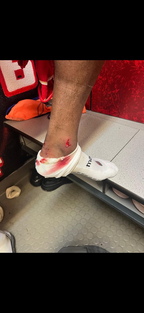 KevSauvage's tweet image. 🚨👀 Voici l&apos;état de la cheville de Rafiki Saïd suite au contact avec Zeno Van Den Bosch dans le rectangle pour lequel le @Standard_RSCL estime qu&apos;il devait recevoir un penalty.
🟨 À l&apos;arrivée, c&apos;est l&apos;ailier 🔴⚪️ qui a reçu une jaune et qui a été obligé de sortir suite à ce…