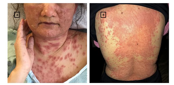 قبل ٣ اسابيع بدت على مضاد حيوي

التحاليل: فشل كلوي، ارتفاع في وظايف الكلى، وال eosinophilia 

التشخيص ؟!!!