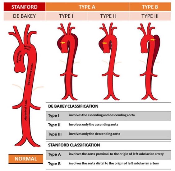 CardioNotion's tweet image. 🚨 La disección aórtica es una carrera contra el tiempo.

Saber clasificarla correctamente puede marcar la diferencia entre la vida y la muerte 🔍

En el hilo de hoy repasamos su clasificación e implicaciones👇🏼
#CardioNotion #CardioEd