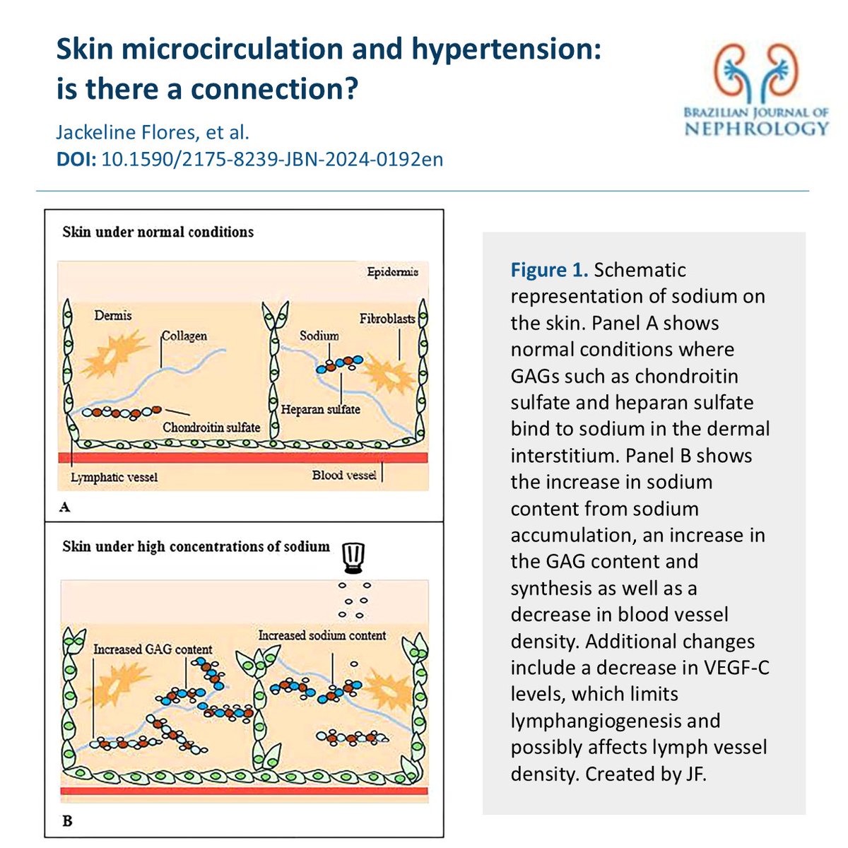 BJNephrology's tweet photo. Review discusses how microvascular rarefaction and skin sodium influence arterial hypertension. Changes in skin capillaries and microvascular density increase peripheral resistance and may guide new therapeutic strategies.

Read more: https://t.co/5evtnaqxKy https://t.co/cjSvOuV7YV