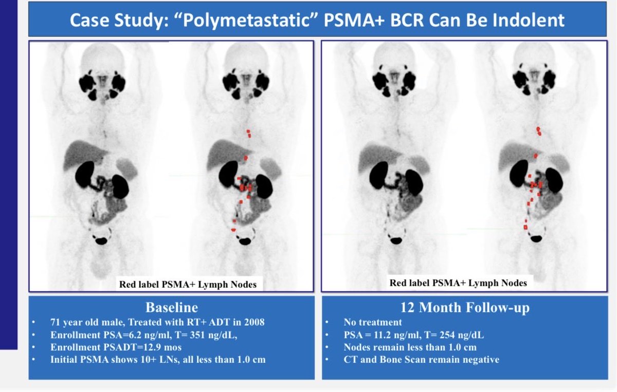 Ravi A Madan M.D. (@dr_ravimadan) on Twitter photo Lots @#ESMO25 re:#BCR #ProstateCancer but over-treatment of this indolent disease remains an important issue 
How does #PSMA imaging factor in? See poster #2393P presented by <a href="/HelenMoonMD/">Helen Moon</a> Saturday 
+PSMA findings in BCR pts shouldn’t be the reason to treat as rPD is rare <a href="/1yr/">Yves</a> Lots @#ESMO25 re:#BCR #ProstateCancer but over-treatment of this indolent disease remains an important issue 
How does #PSMA imaging factor in? See poster #2393P presented by <a href="/HelenMoonMD/">Helen Moon</a> Saturday 
+PSMA findings in BCR pts shouldn’t be the reason to treat as rPD is rare <a href="/1yr/">Yves</a>