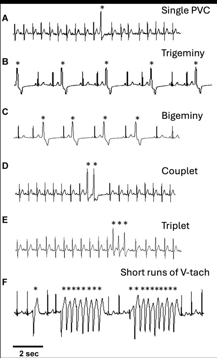 Premature Ventricular Contractions (PVCs) 

Premature Ventricular Contractions (PVCs) are early heartbeats originating from the ventricles instead of the atria. PVCs are categorized based on their origin, morphology, frequency, and pattern. Here's a breakdown of the types of PVCs