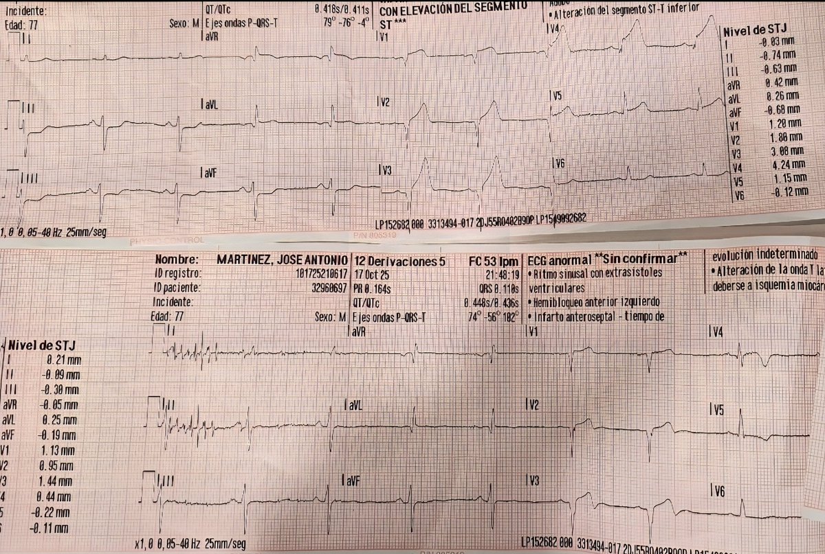 IAM anteroseptal,lateral,con afectación de TCI y DA. Imagen especular en cara inf. Tratamos SVA con mejoría clínica cediendo el dolor, cortejo y corrigiendo ecg notablemente.Alerta Hospitalaria #cateterismo.Traslado sin complicaciones.Pasión por la #Emergencia (Las Rozas,#Madrid)